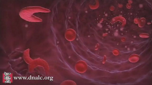 Anemic Blood Cells